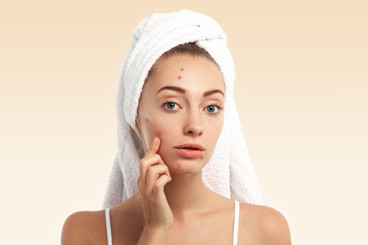 Understanding Acne: Causes, Myths, and How Cleanser Formulas Can Help
